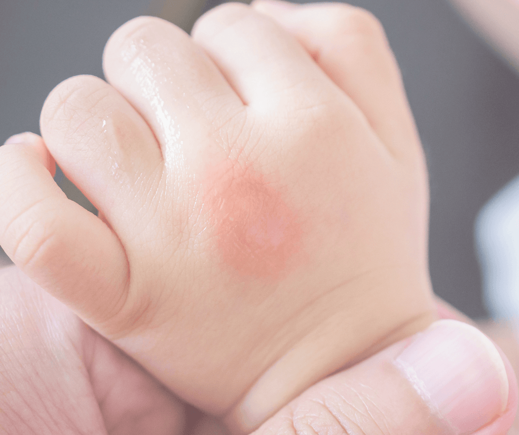 Managing Your Child's Eczema: A Guide For New Parents